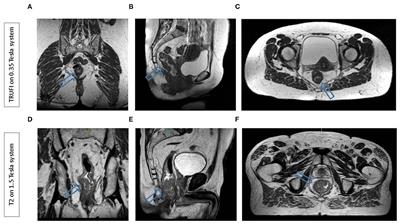 MR-Guided Radiotherapy for Rectal Cancer: Current Perspective on Organ Preservation